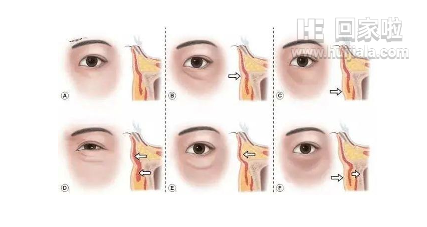 去眼袋最安全最有效的方法,抽眼袋脂肪要多少钱,正规医院做眼袋多少钱